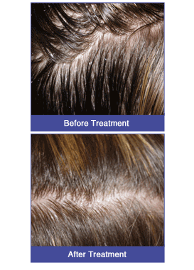 Dermatitis-New-Side